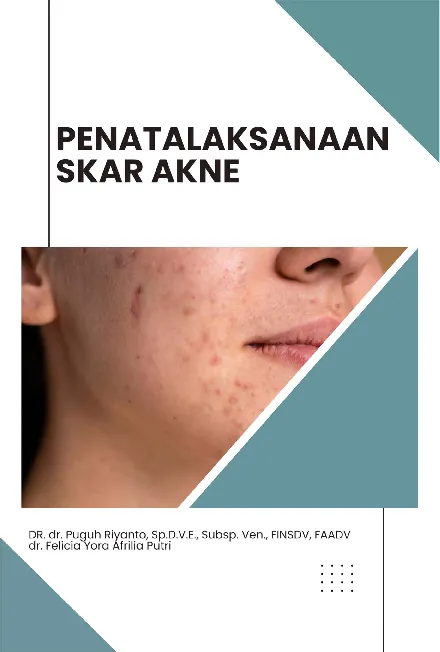 Penatalaksanaan Skar Akne