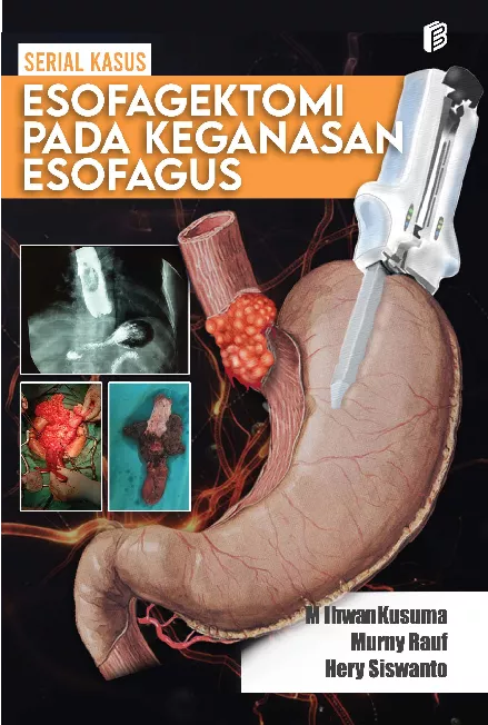 ESOFAGEKTOMI PADA KEGANASAN ESOFAGUS