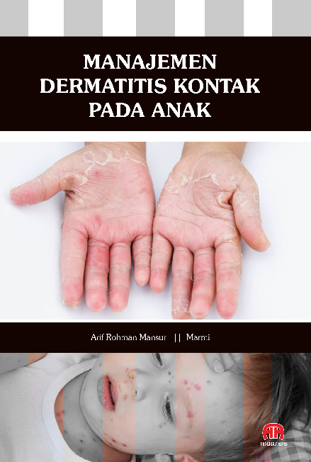 MANAJEMEN DERMATITIS KONTAK PADA ANAK