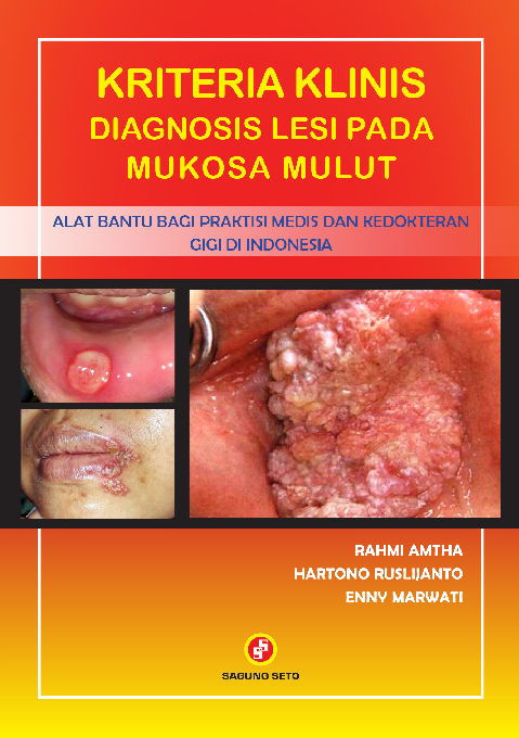 Kriteria Klinis Diagnosis Lesi Pada Mukosa Mulut