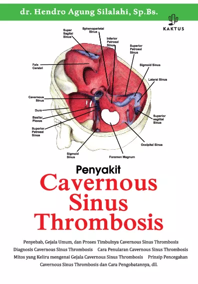 Penyakit Cavernous Sinus Thrombosis